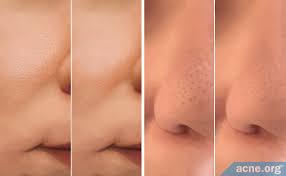 Can You Reduce The Size Of Your Skin Pores? - Acne.org