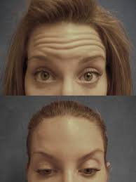 botox to forehead wrinkles forehead wrinkles botox brow lift botox results
