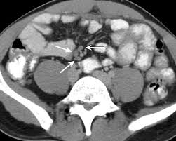 Mesenteric Lymph Nodes Seen At Imaging Causes And Significance Radiographics
