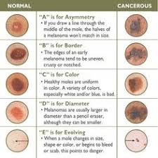 There are three main types of skin cancers: Melanoma