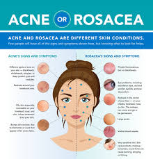 How to treat acne rosacea language:de. Aadmember On Twitter Acne Or Rosacea This Infographic Shows Patients The Differences Rosacea Can Cause Acne Like Breakouts And Redness Making It Difficult To Distinguish Learn More From The Aad Https T Co Ptxxxlkufm Https T Co Fbjidljf45