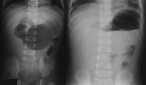 Image result for Midgut Volvulus