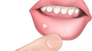 Image result for mouth ulcer on tongue)