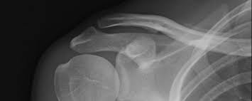 Image result for Shoulder MRI