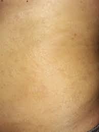 Tetapi terdapat beberapa penyiasatan yang boleh dibuat untuk mengesahkan seseorang itu mempunyai panau. Ubat Psoriasis Psoriasis Adalah Penyakit Kulit Yang Di Mulai Dengan Tompok Merah Seperti Ruam Gatal Gatal Selepas Itu Ia Akan Mati Dan Menjadi Hitam Dan Menjadikan Kulit Bersisik Lalu Meninggalkan Parut Putih Seperti Panau Ia Akan