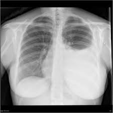 A loculated pleural effusion is the major radiographic hallmark of parapneumonic effusion or empyema (see fig. Pleural Effusion Radiology Reference Article Radiopaedia Org