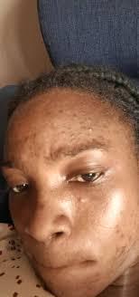 Hi guys what home remedies can I use to remove dark spots and pimples  please help guys my face is a disaster