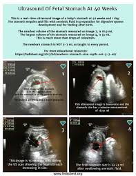 the newborn stomach size myth it is not 5 7 ml fed is best