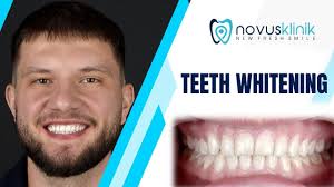 Cheick’s Confident New Look: Dental Crowns in Turkey by Dr. Gulsah Dulger  at Novusklinik