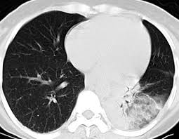 Image result for Pulmonary Intoxicant