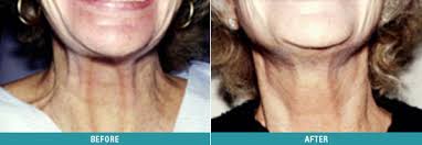 Maybe you would like to learn more about one of these? Botulinum Toxin Treat Platysmal Bands Beauty Before Age