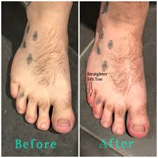 Listers/ Durlacher Corns