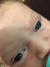 From grass to pet dander, scabies is an infestation of the skin by microscopic mites. My Baby Is 3 Weeks And Has These Little Red Dots On Her Face What Is It And Should I Be Concerned Glow Community