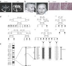 Mutations in the facilitative glucose transporter GLUT10 alter angiogenesis  and cause arterial tortuosity syndrome