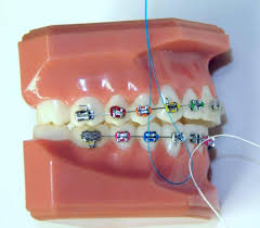 Taking care of your teeth can be challenging with braces. How Do You Floss With Braces Ask An Orthodontist Com