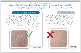 كم يكلف زرع الشعر في تركيا Hair Transplant Acls Transplant
