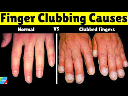 Image result for Digital Clubbing