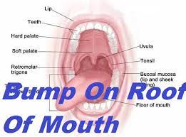 I have a bump very similar to that on the roof of my mouth in the back. Bump On Roof Of Mouth Grow Health