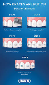 Why use dental wax for braces? Getting Braces Put On Oral B