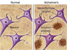 You are going to email the following the molecular basis of alzheimer's plaques message subject (your name) has forwarded a page to you from science 16 Mio Eur Fur Ac Immune In Serie D Finanzierung