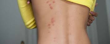 Le plus souvent les piqûres sont alignées. Piqure De Punaise De Lit Comment La Reconnaitre Centre D Aide Mamawax