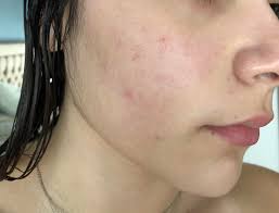 Because apple cider vinegar has antibacterial properties so it is one of the best home remedies for a bacterial infection on the skin. Skin Concerns What To Do About These Red Spots Patches Left After Acne Skincareaddiction