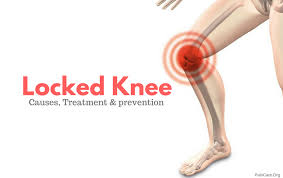With pseudo knee locking, you can't move your knee becau. Locked Knee Liberal Dictionary
