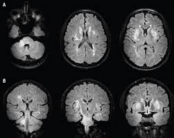 Image result for Brain Lesion