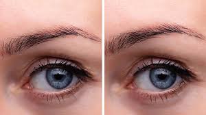 Eyebrow Lift Botox | Botox brow lift | Derma Institute New Zealand