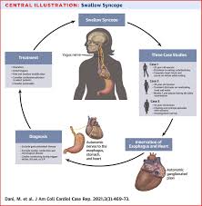 Image result for Exercise Induced Syncope