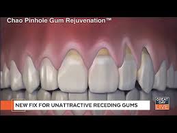 10 Tips To Minimize Gum Recession At Home Youtube