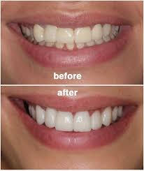 Pin On Best Dentist Bangalore