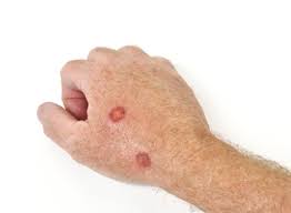 We did not find results for: Causes Symptoms And Treatments For Seborrheic Keratosis Arlington Dermatology