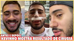 A 6 meses atrás, na verdade a 1 ano atrás pouco depois de remover os cistos da mão eu descobri que uma década de sobrepeso causados pelo meu hipotiroidismo haviam lesionando não só meu. Kevinho Mostra Antes E Depois De Cirugia No Nariz Youtube