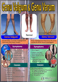 Image result for Genu Varum