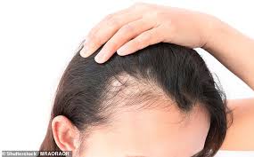 High doses of vitamin a and medications derived from it can cause hair loss. Dr Ellie Cannon My Hair Is Thinning Could It Be Caused By Heartburn Medicine Daily Mail Online