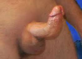 Peyronies Disease Pictures