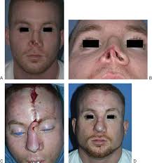 Management of Nasal and Perinasal Soft Tissue Injuries