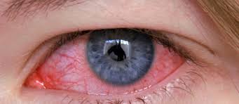 Image result for Conjunctivitis