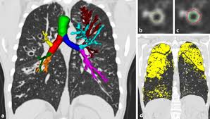 P dies behindert die reinigungsfunktion der lunge. Computertomographie Der Lunge Bei Mukoviszidose Springerlink