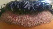 Bad Ingrown Hairs After Brazilian Wax