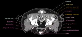 It attaches to the walls of the lesser pelvis, separating the pelvic cavity from the perineum inferiorly (region which includes the in this article, we shall look at the anatomy of the muscles that make up the inferior lining of the cavity; Abdomen Und Beckenanatomie Des Ruden Im Ct