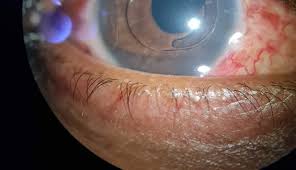 Image result for Hyphema