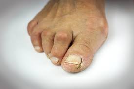 Hammer Toe Treatment Crooked Claw Toes Perth Foot Centre hammer toe treatment crooked claw toes