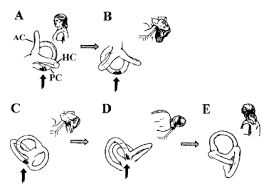 Avoid driving a car or operating heavy machinery if you experience frequent dizziness without warning. Positional Vertigo An Overview Sciencedirect Topics