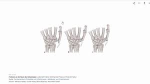 Der mittelhandknochen wird durch den zug der hier ansetzenden sehne des m. Physiolink Tutorial Suche Youtube
