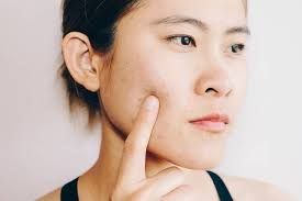 7 effective ways to get rid of clogged oil glands on face. 9 Holistic Acne Remedies You Can Find At Home For Clear Skin