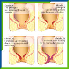 Image result for hemoroid human