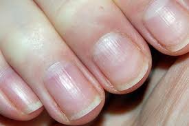 Female pattern hair loss occurs when new hair grows in finer and thinner than the original hair, resulting in lower hair volume and, eventually, halted growth. Why Are My Nails So Brittle
