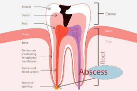Maybe you would like to learn more about one of these? Abscess Tooth While Pregnant Causes Symptoms Preventions You Should Be Aware Of